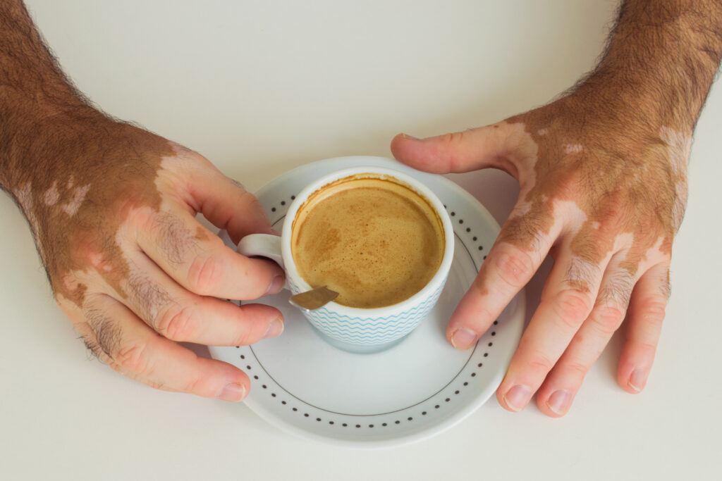 Mains d'une personnes atteinte de vitiligo avec un café - page conseils pratique