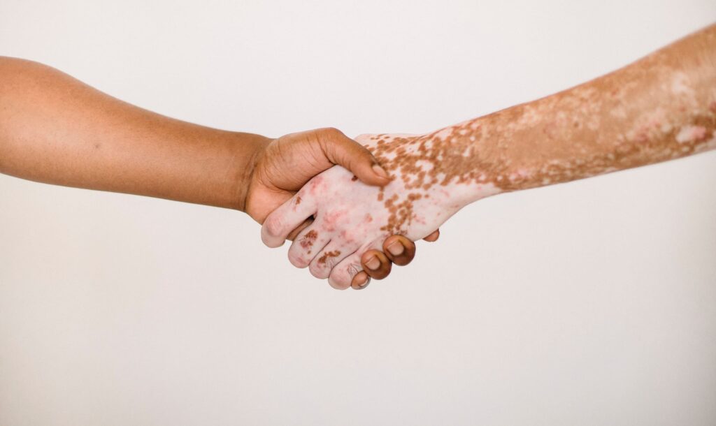 Les traitements du vitiligo - Association Française du Vitiligo