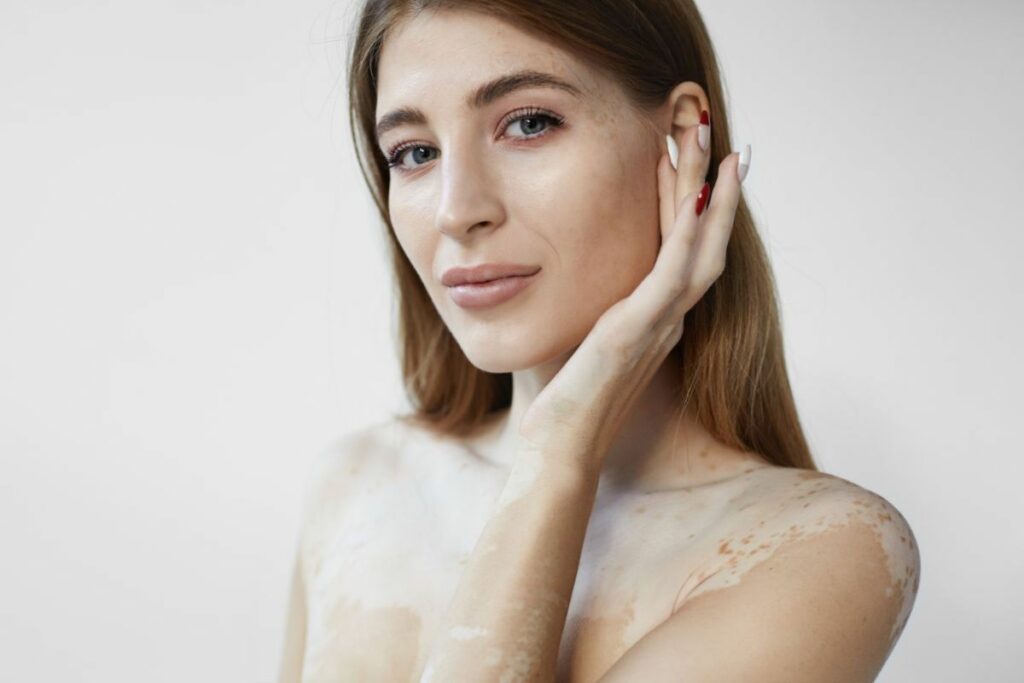 femme vitiligo