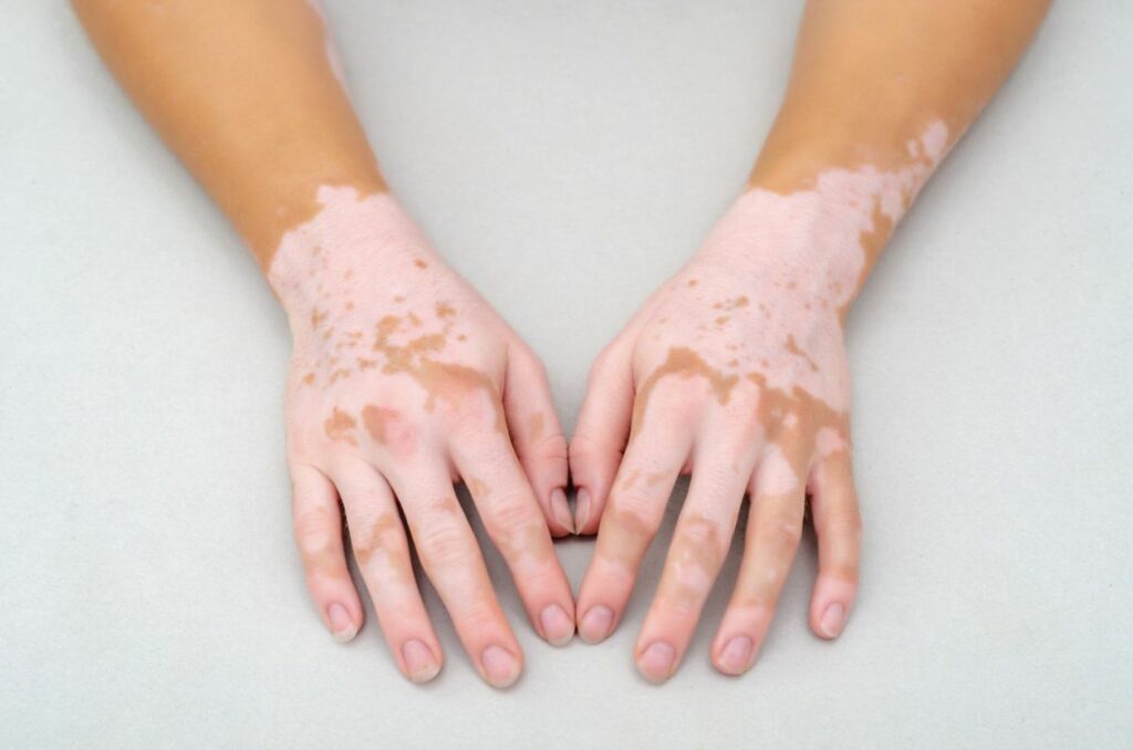 Mains vitiligo