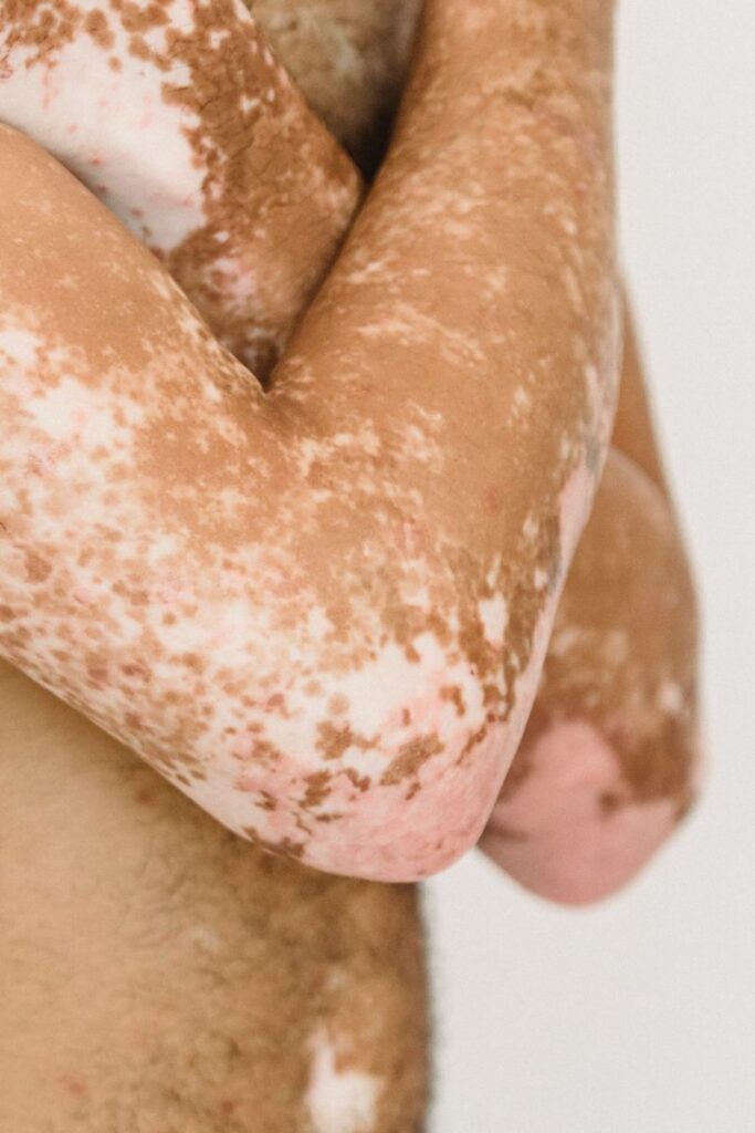 Homme torse bras vitiligo
