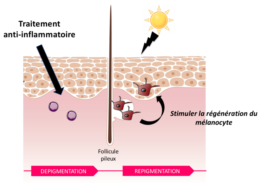 Stratégie thérapeutique vitiligo