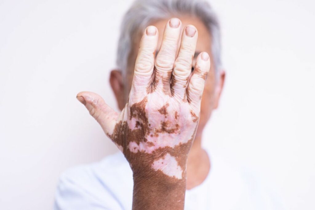 Homme main vitiligo