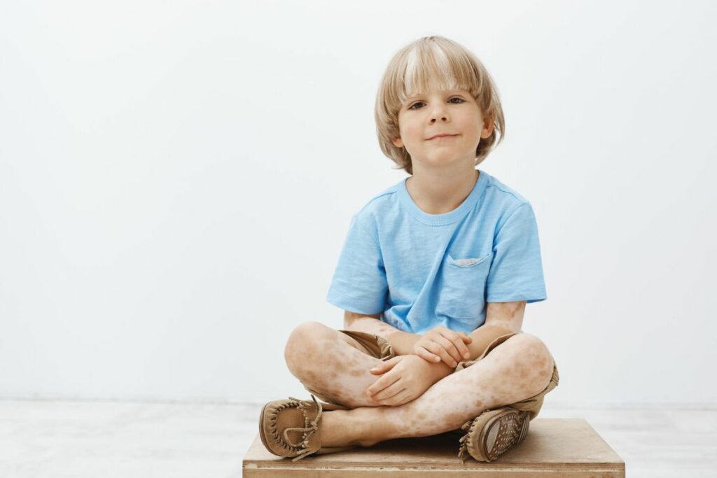 enfant vitiligo