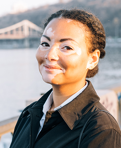 femme pigmentée taches vitiligo