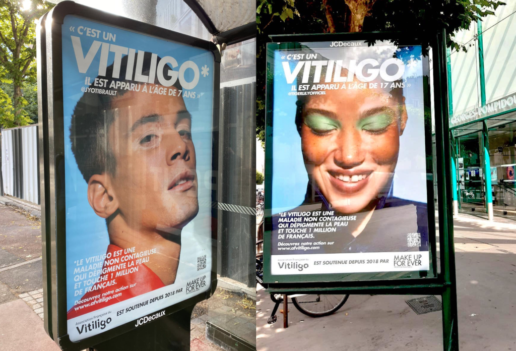 Affiches vitiligo France