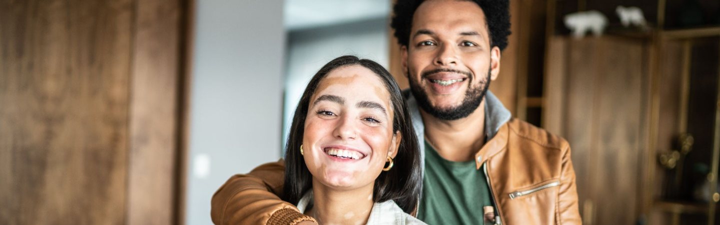 Un couple souriant, la jeune femme presentant un vitiligo sur le visage